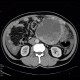 Retroperitoneal sarcoma, sarcoma of retroperitoneum, biopsy, CT guided biopsy: CT - Computed tomography